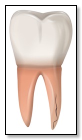 vertical root fracture usually cannot be saved